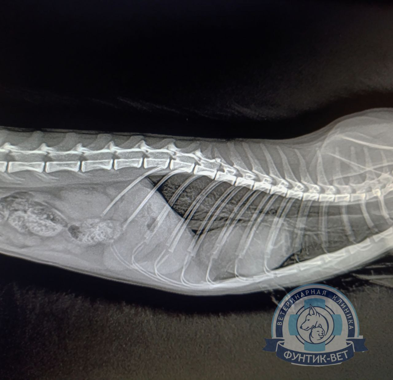 Перитонео-перикардиальная диафрагмальная грыжа